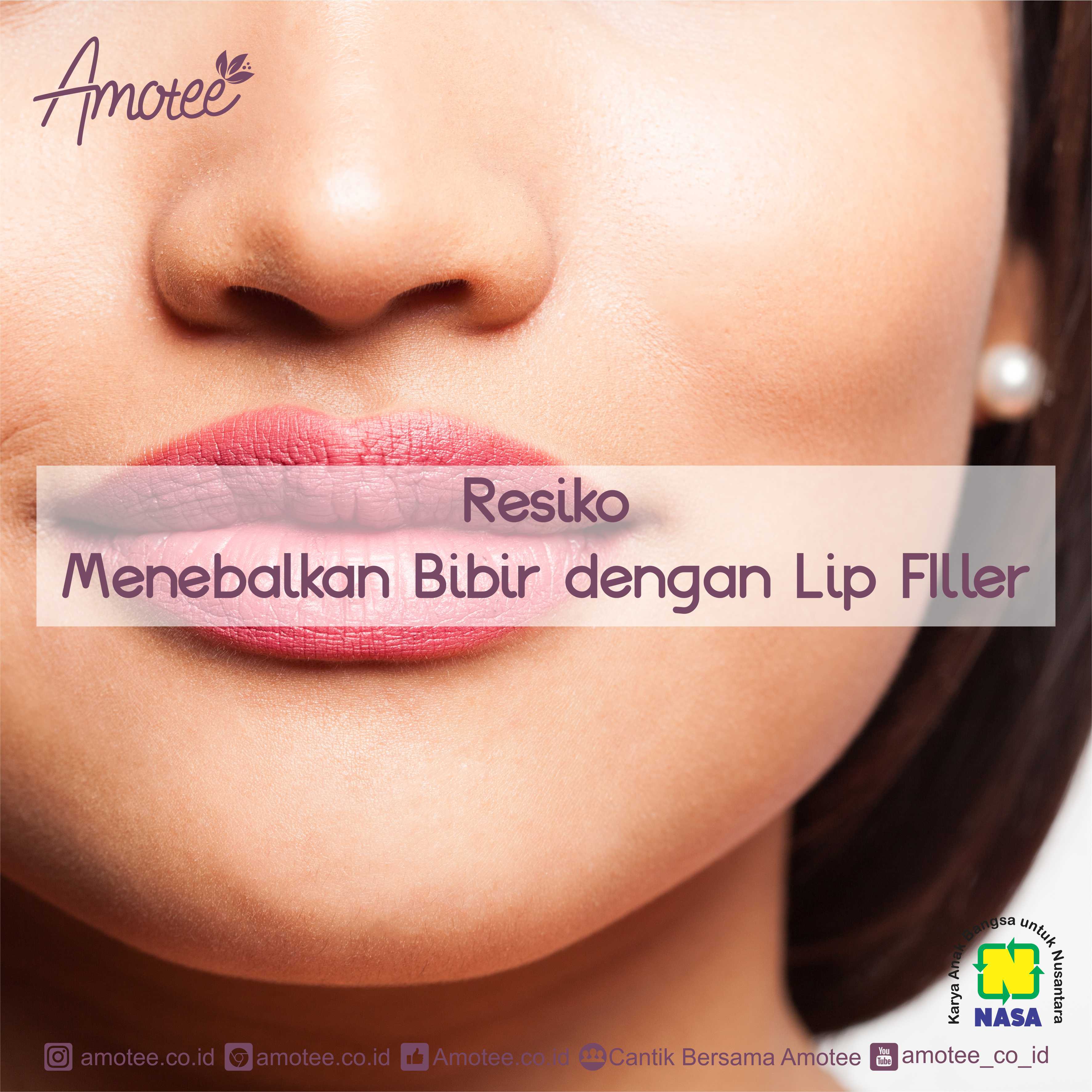 Resiko menebalkan bibir dengan lip filler