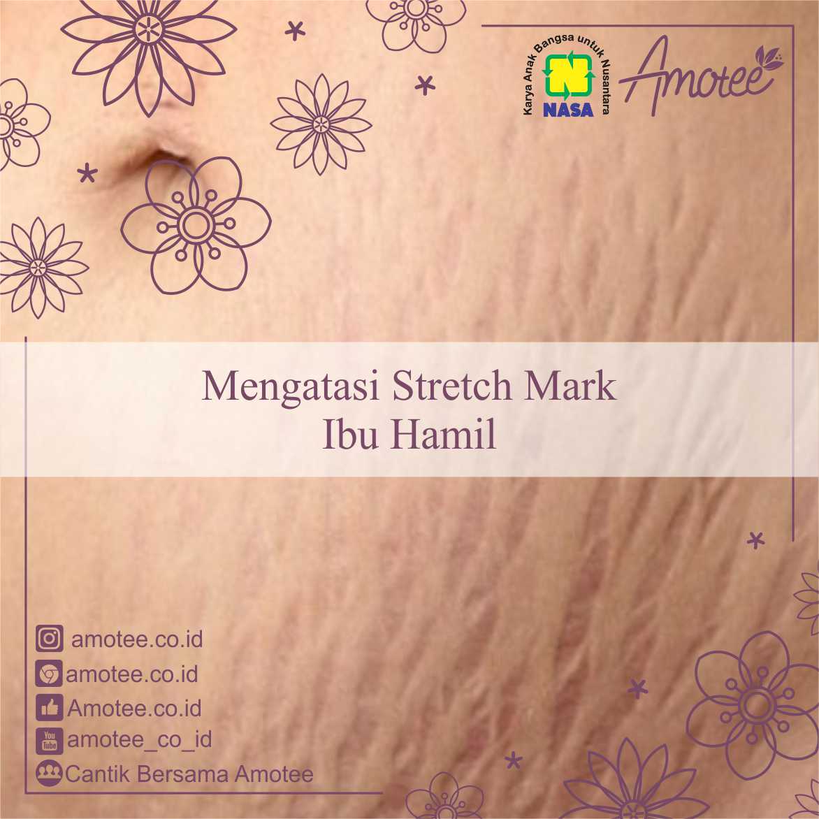 Mengatasi Dan Mencegah Stretch Mark Setelah Ibu Melahirkan