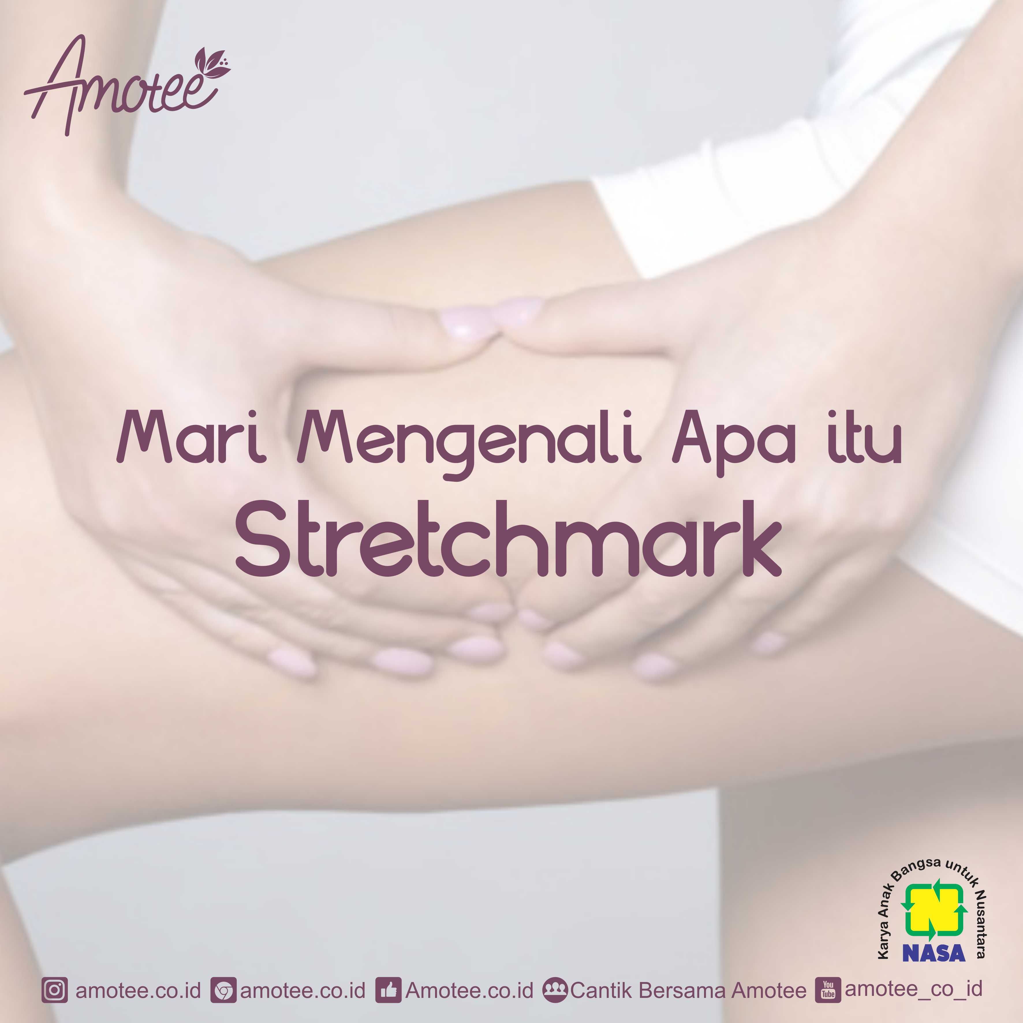 Mengenal Stretch Mark