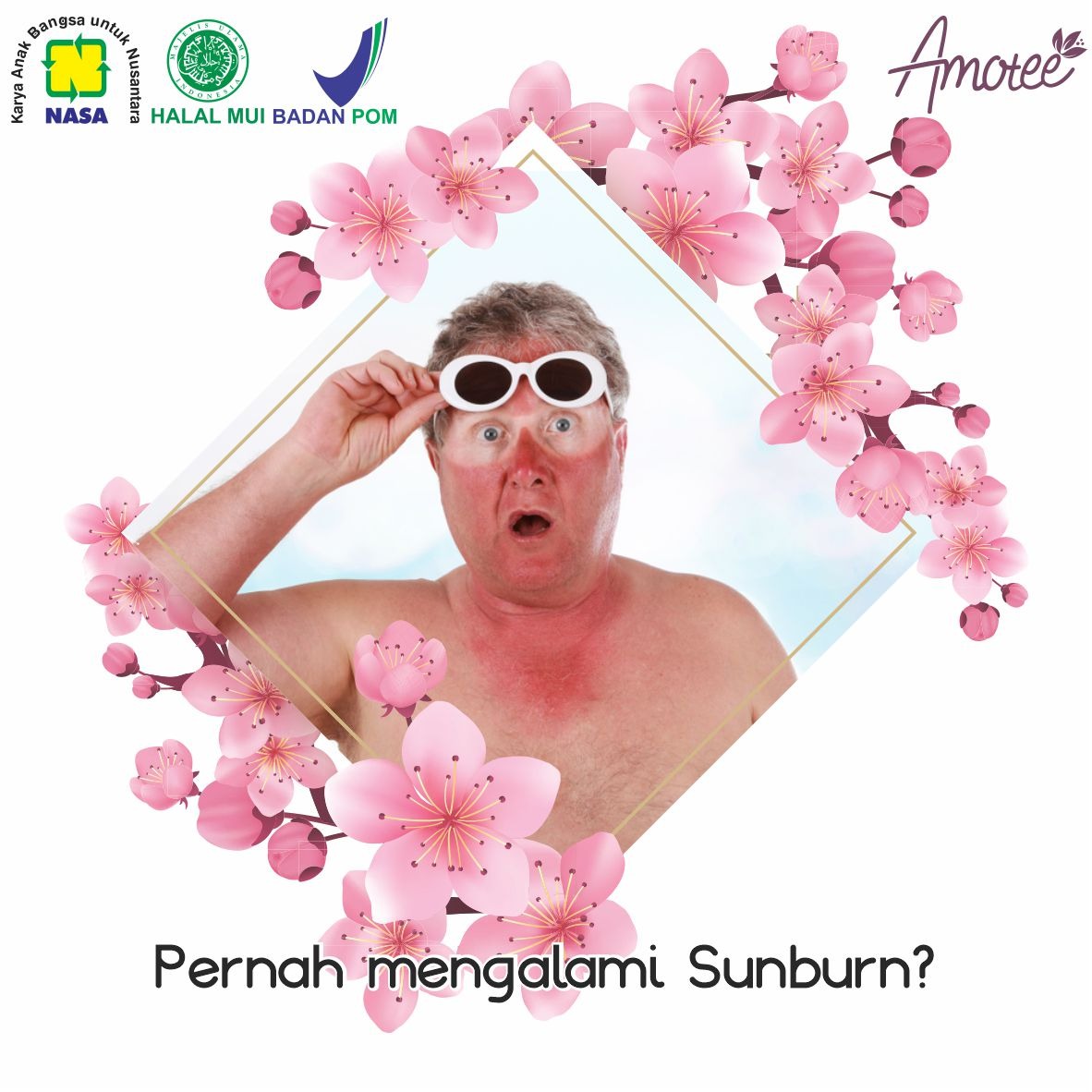 Pernah Mengalami Sunburn?